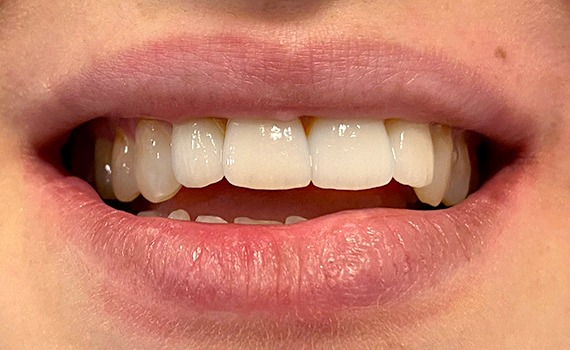 Caz 1 estetica dentara - dupa