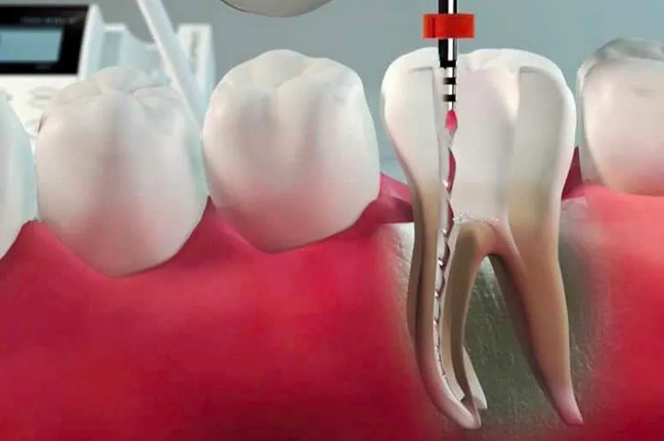 Curățare canal endodontie