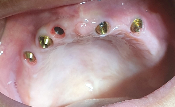 Caz 2 implanturi dentare - inainte