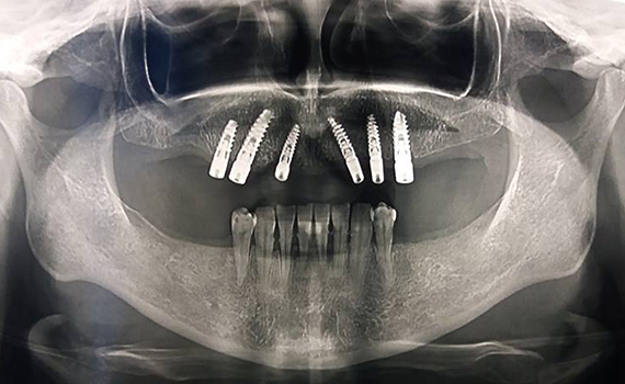 Caz 10 implanturi dentare - inainte