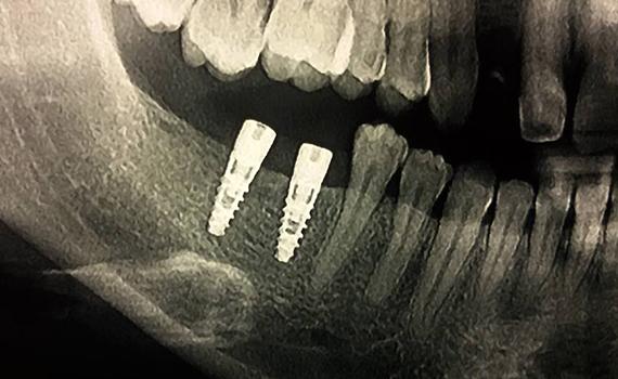 Caz 11 implanturi dentare - inainte
