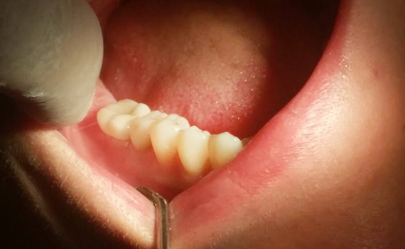 Caz 11 implanturi dentare - dupa