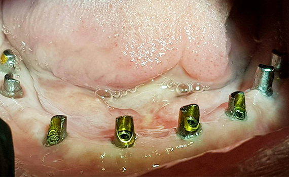 Caz 13 implanturi dentare - inainte