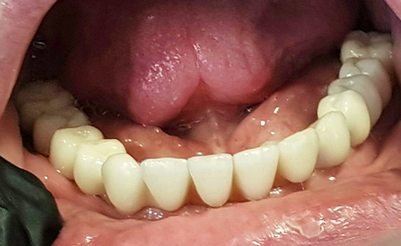 Caz 13 implanturi dentare - dupa