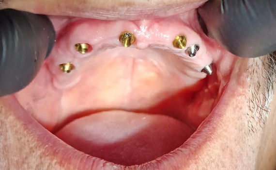 Caz 14 implanturi dentare - inainte