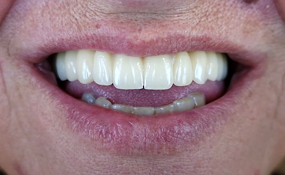 Caz 15 implanturi dentare - dupa