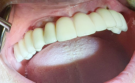 Caz 2 implanturi dentare - dupa