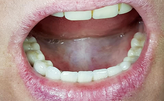 Caz 5 implanturi dentare - dupa