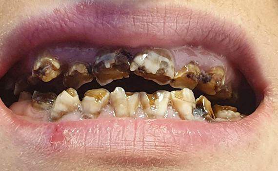 Caz 1 implanturi dentare - inainte