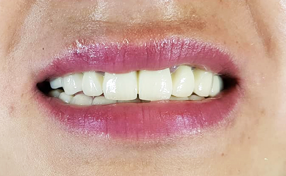 Caz 1 implanturi dentare - dupa