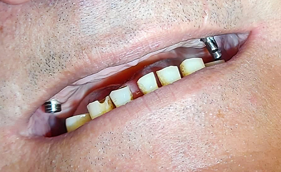 Caz 7 implanturi dentare - inainte