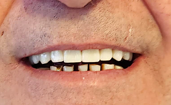 Caz 7 implanturi dentare - dupa