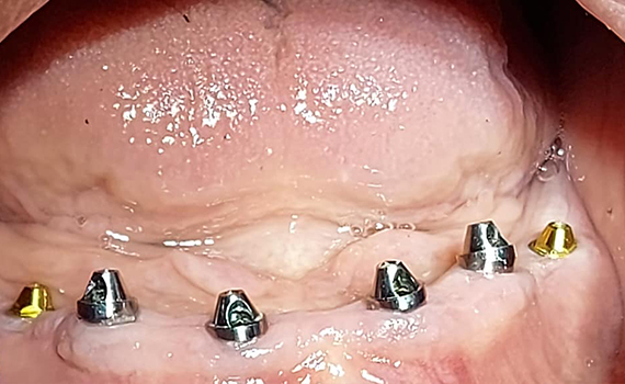 Caz 8 implanturi dentare - inainte
