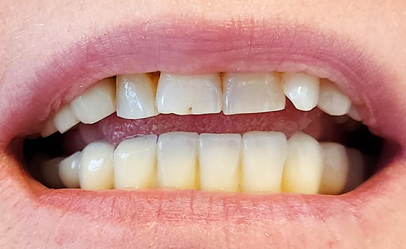 Caz 9 implanturi dentare - dupa