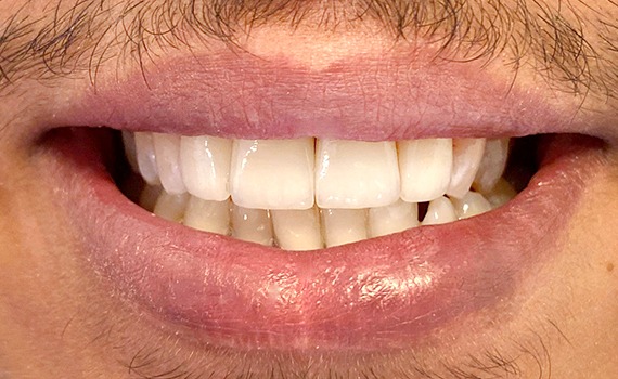 Caz 2 estetica dentara - dupa