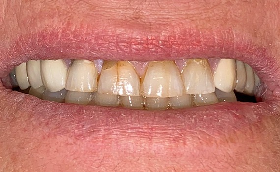 Caz 4 estetica dentara - inainte