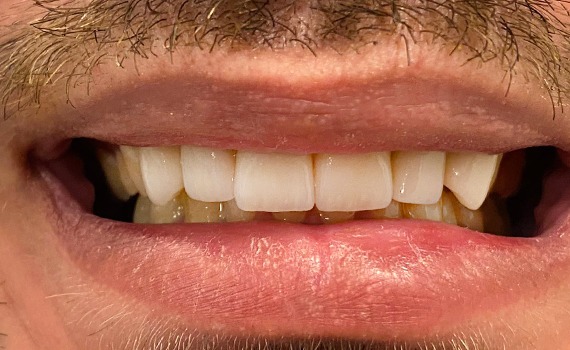Caz 6 estetica dentara - dupa