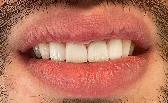 Caz 7 estetica dentara - dupa