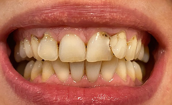 Caz 8 estetica dentara - inainte