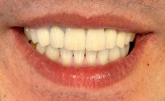 Caz 9 estetica dentara - dupa