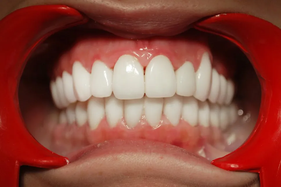 Obturare canal endodontie