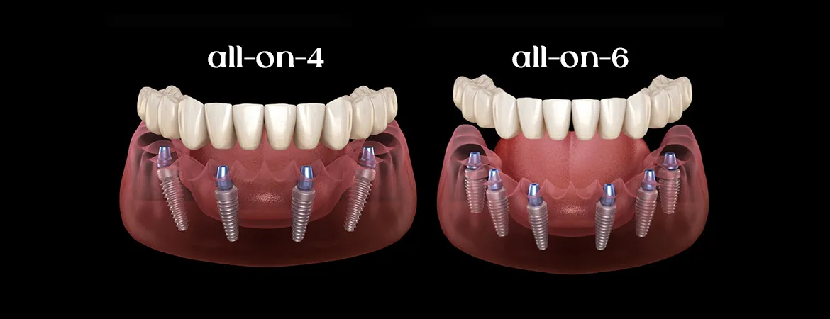 implanturi All-on-4 - All-on-6